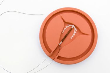Hormonspirale in einer Beispielansicht